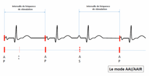 Pacemaker Pacing Modes: VVI, DDD, AAI, DDDR Explained | Cardiocases