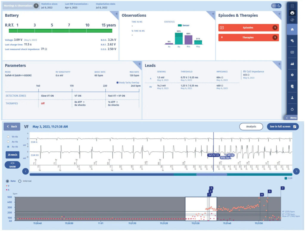 Competing counters: MicroPort ICD tracing (EGM)