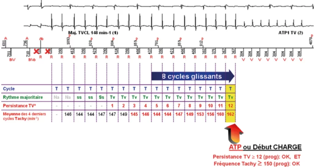 Exemple de comptage d’une TV : majorité TV sur 8 cycles glissants, persistance TV à 12, fréquence Tachy d’au moins 150 min-1 et délivrance de l’ATP
