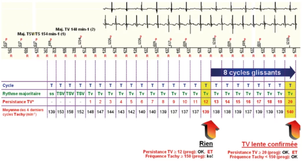 Exemple de TV lente : la fréquence se situe en zone TV lente, la persistance de TV lente est atteinte à 20 cycles et aucune thérapie n’est délivrée