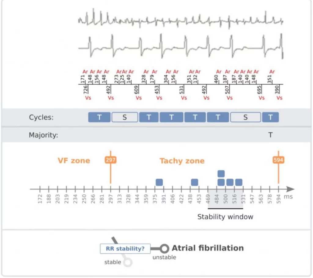 Unstable RR intervals in the RR histogram: the stability criterion is not met and PARAD+ classifies the rhythm as atrial fibrillation
