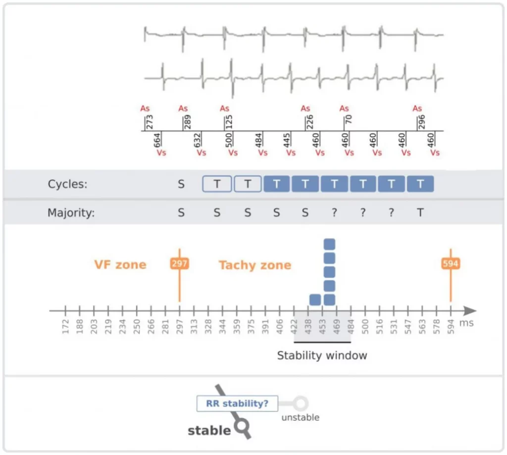 Stable RR intervals grouped within the stability window: PARAD+ goes on to identify the rhythm