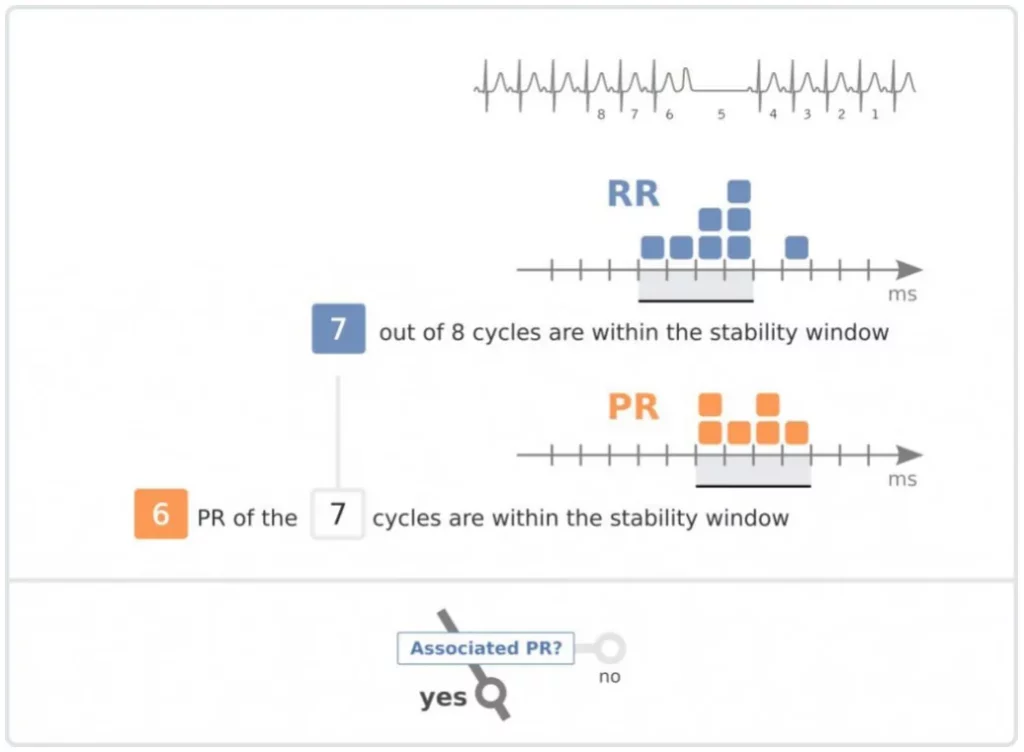 RR and PR histograms: 7 of 8 cycles within the stability window and 6 of 7 PR intervals within the association window, the PR are associated