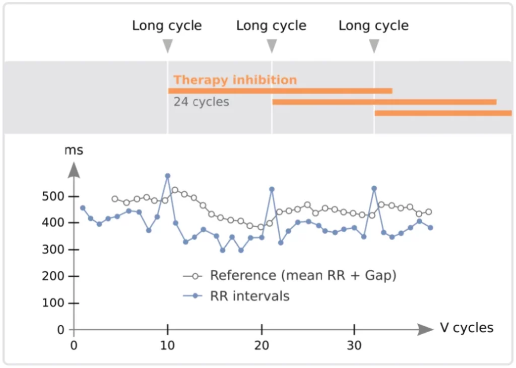Long cycle search: ventricular cycles longer than the reference (mean RR + gap) inhibit VT therapy for 24 cycles