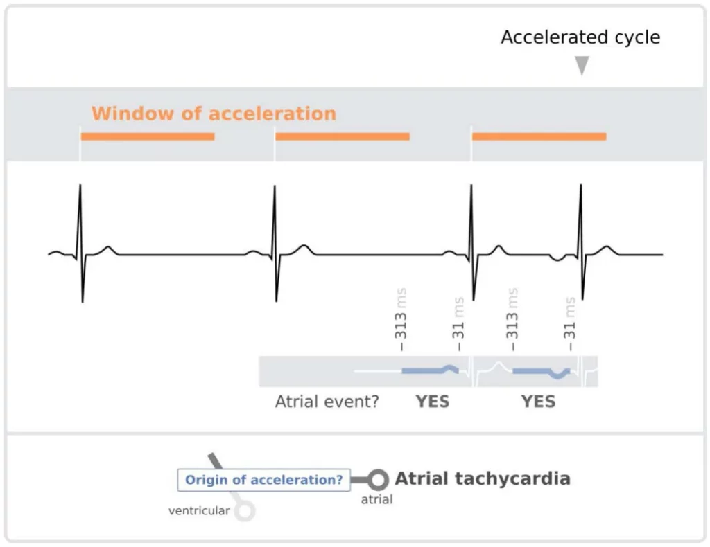 Accelerated cycle whose two R waves are each preceded by an atrial event within 31 to 313 ms: acceleration of atrial origin, atrial tachycardia