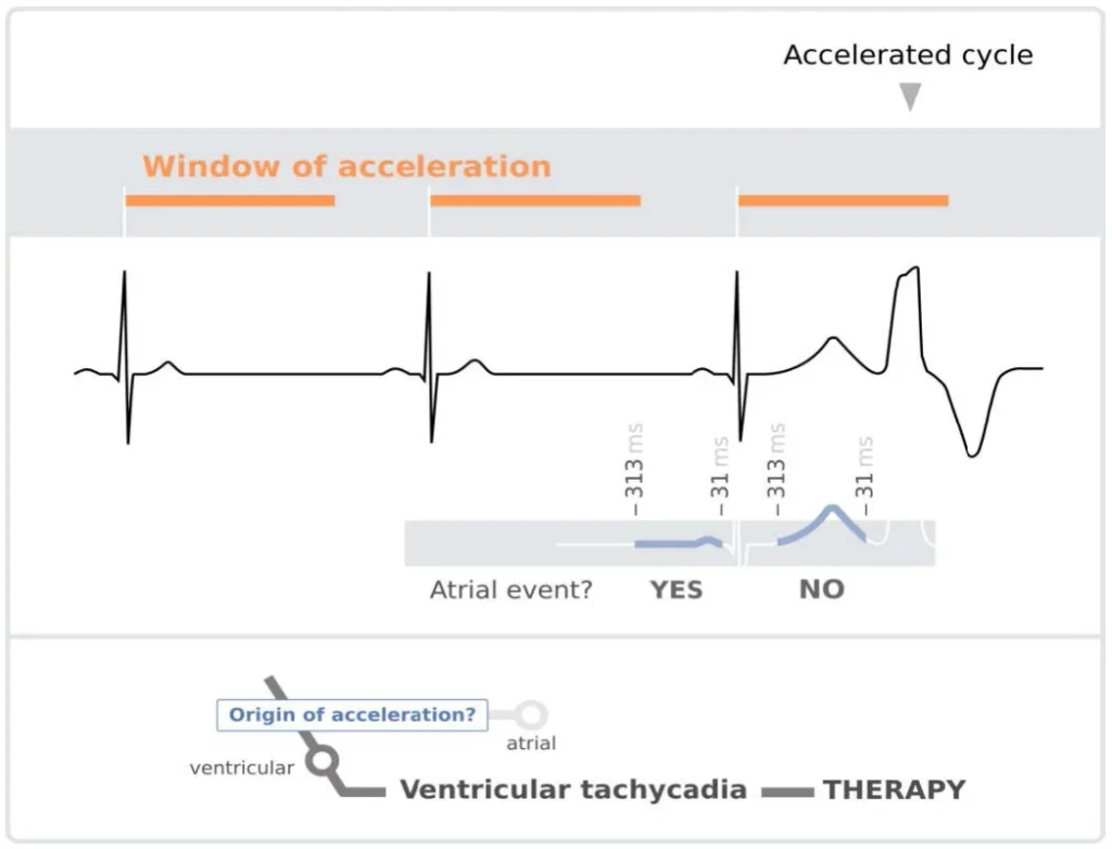 Accelerated cycle whose second R wave is not preceded by a P wave: acceleration of ventricular origin, ventricular tachycardia therapy