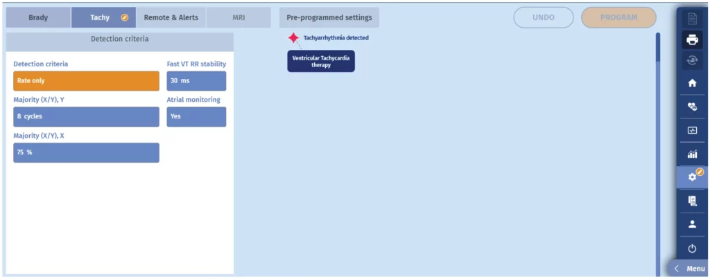 Programmer screen with discrimination de-activated (rate only) in a patient with complete AV block