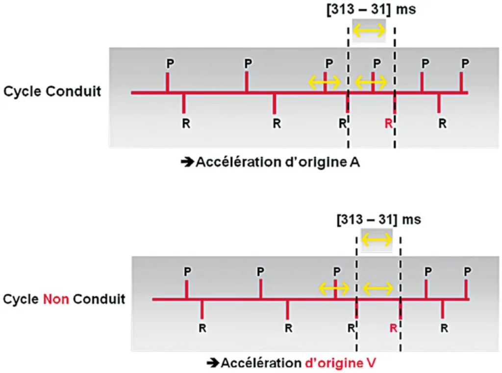 Cycle conduit et cycle non conduit : accélération d’origine A ou V selon la fenêtre [31 – 313] ms