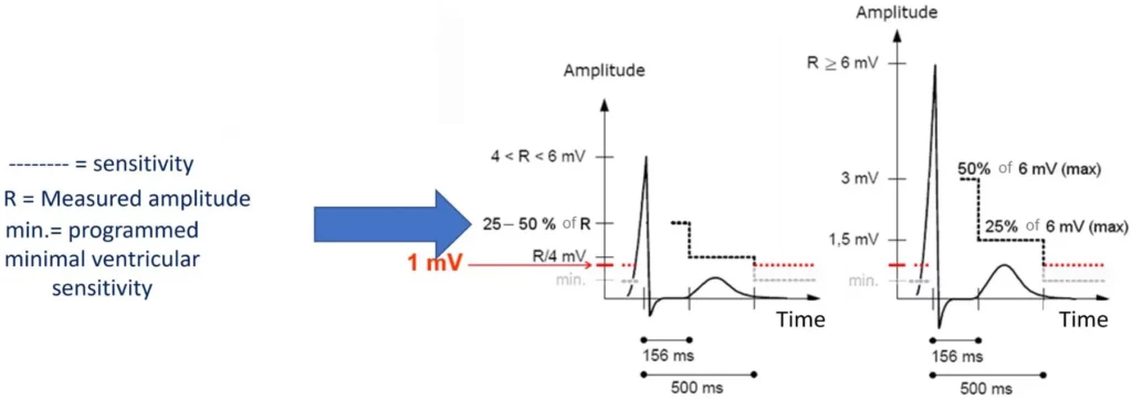 Automatic ventricular sensitivity after a sensed R wave of 4 mV or more: two plateaux, then a 1 mV floor after 500 ms