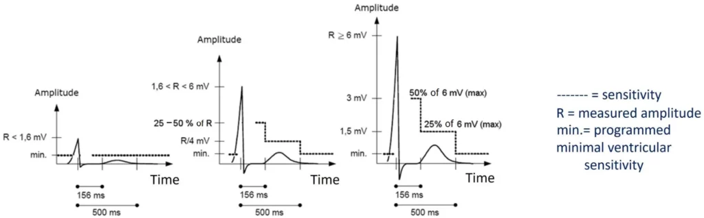 Automatic ventricular sensitivity for R waves below 1.6 mV, between 1.6 and 6 mV and above 6 mV, returning to the programmed sensitivity after 500 ms