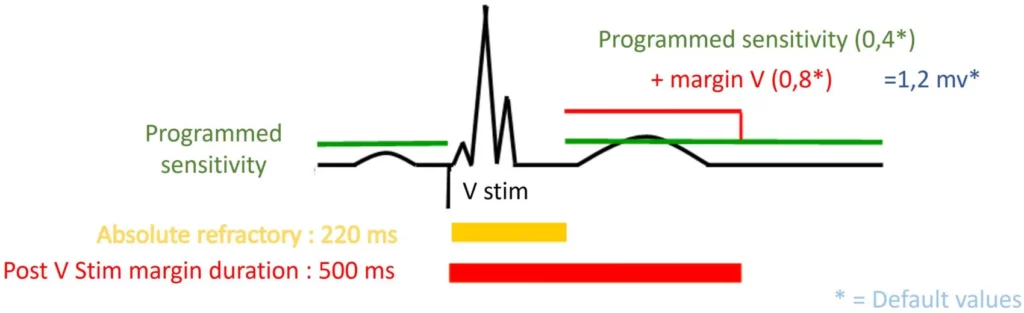 Sensitivity after ventricular pacing with a short cycle in the last six cycles: back to the programmed sensitivity after 500 ms