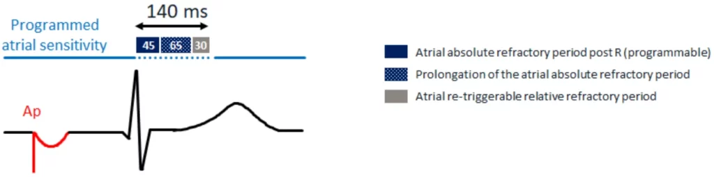 Atrial sensitivity control after atrial pacing: 45 ms absolute refractory period prolonged by 65 ms and a 30 ms re-triggerable relative refractory period (140 ms)