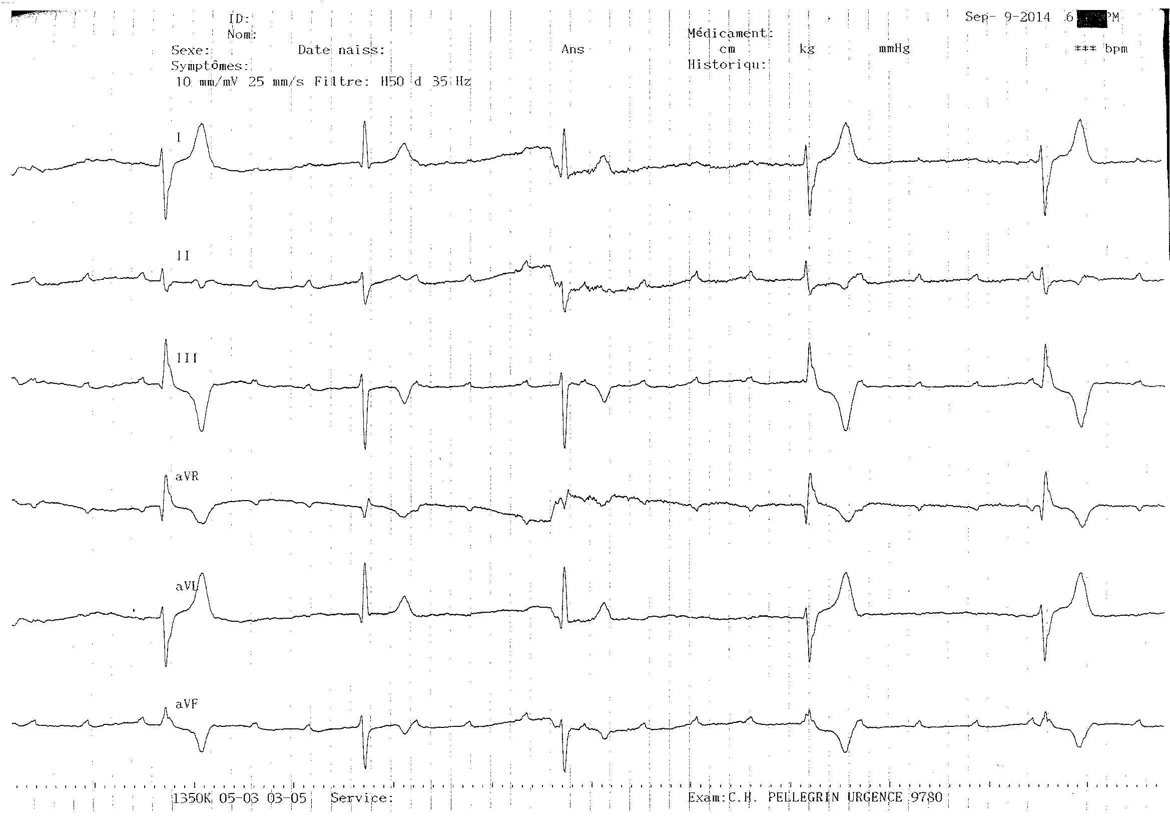 trace-1-10-ecg