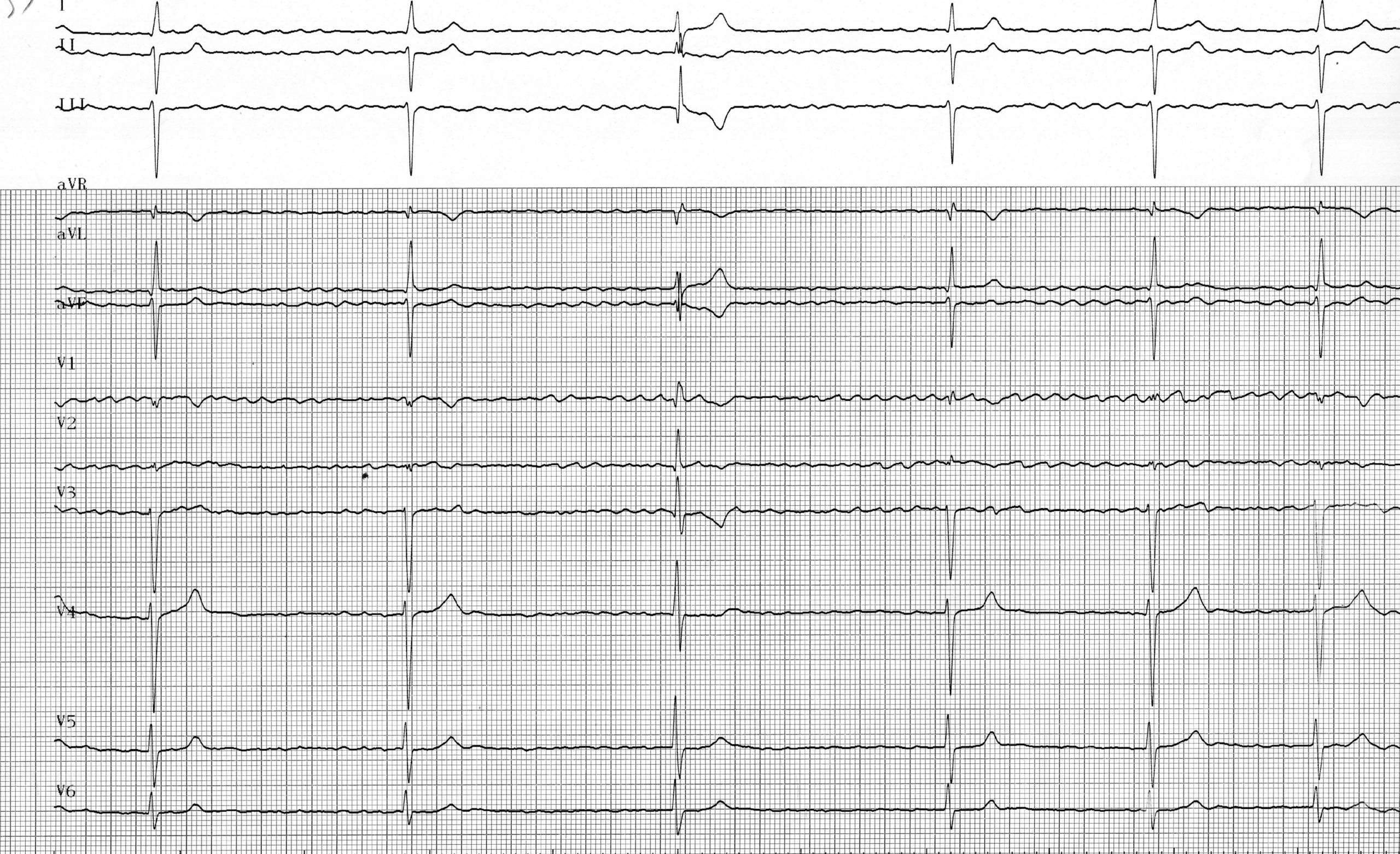 trace-1-11-ecg