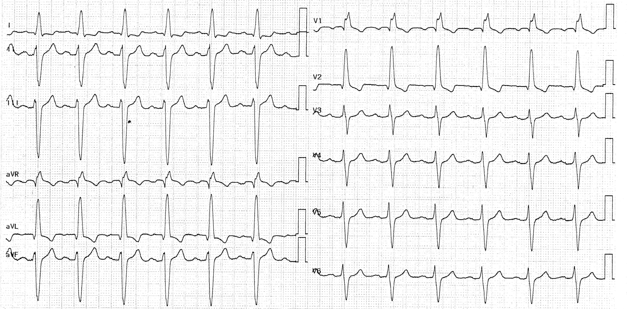 trace-1-3-ecg