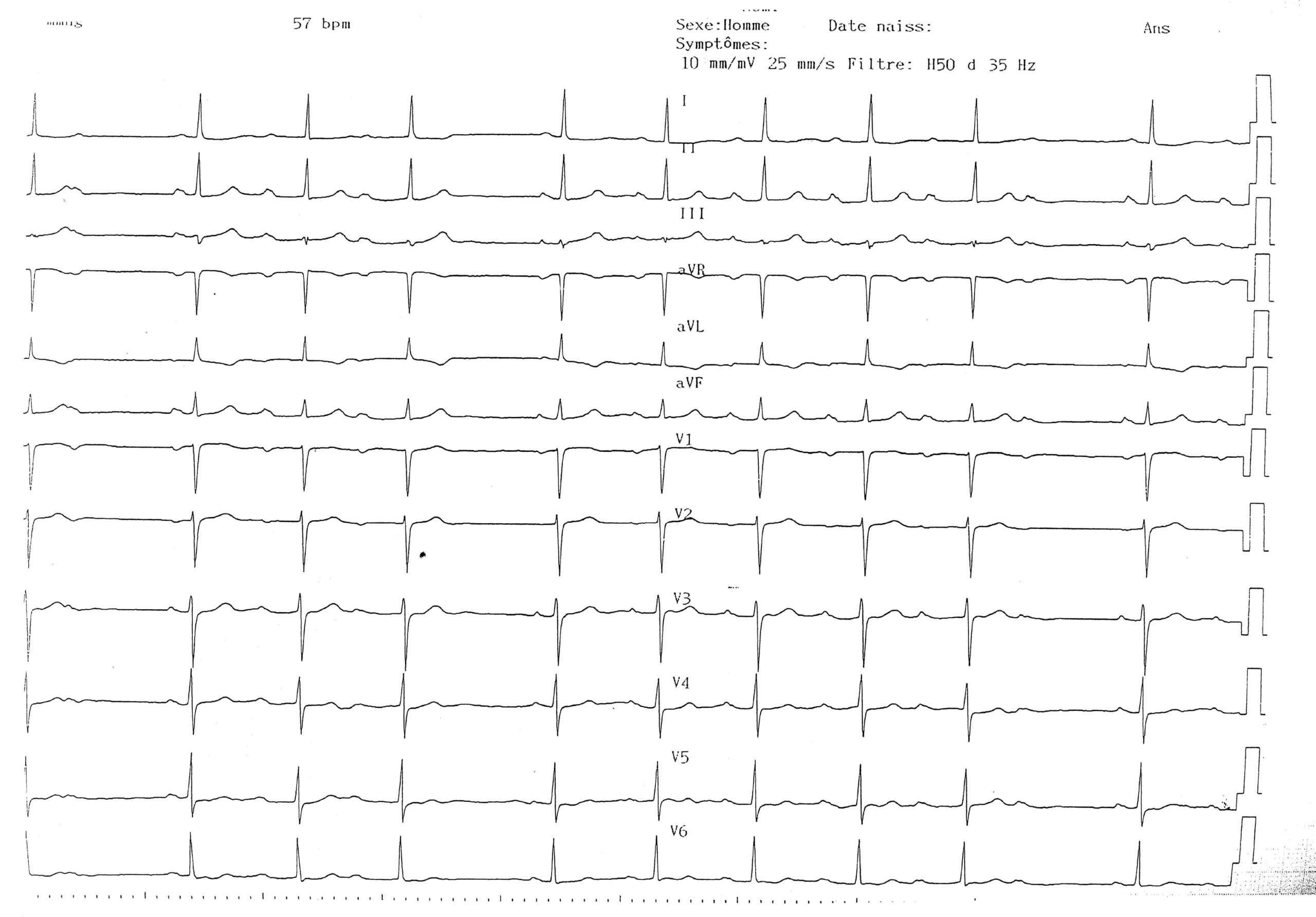 trace-1-4-ecg