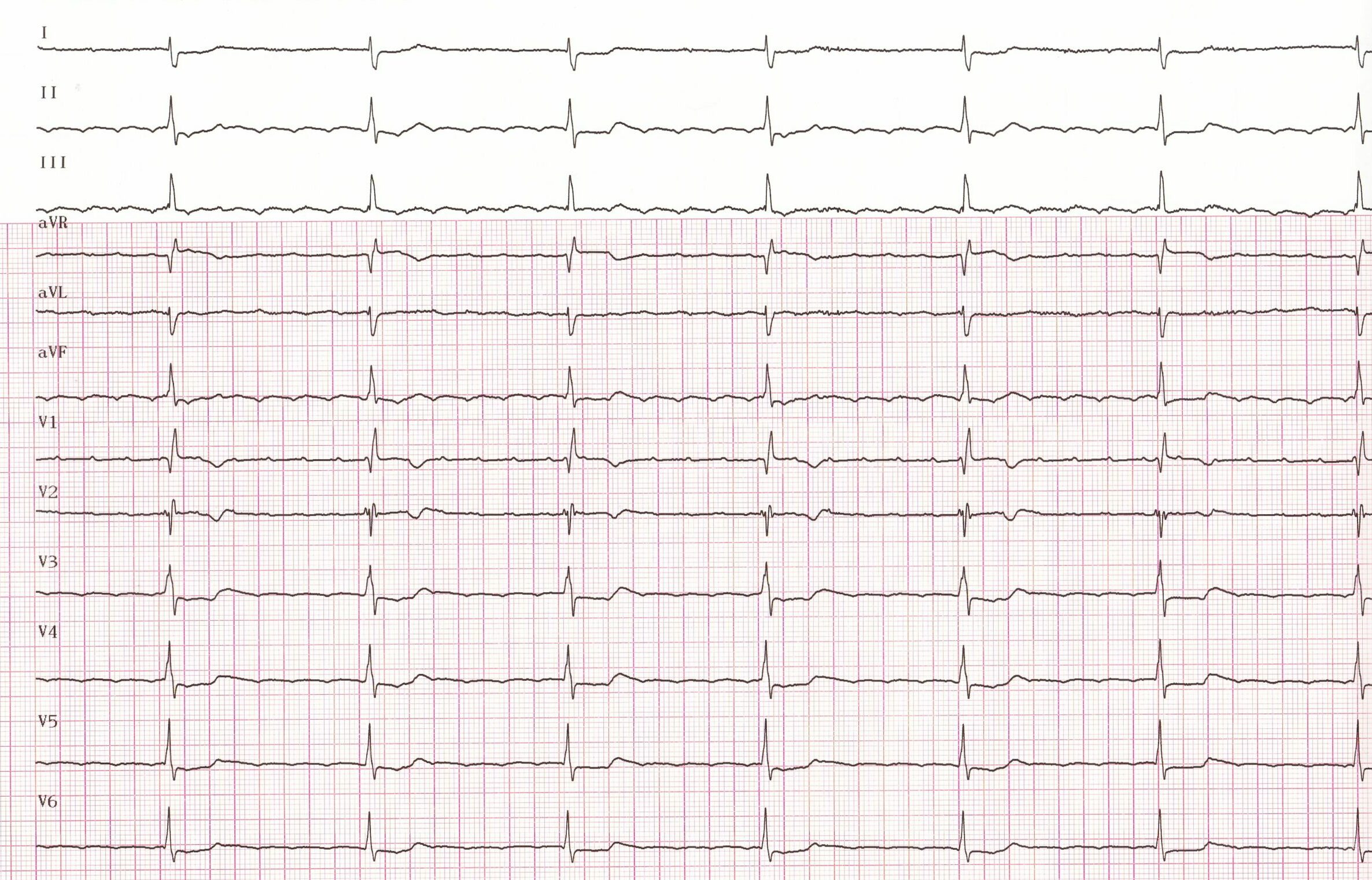trace-1-5-ecg