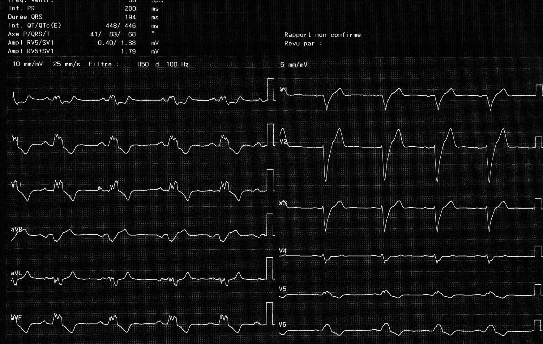 trace-1-6-ecg