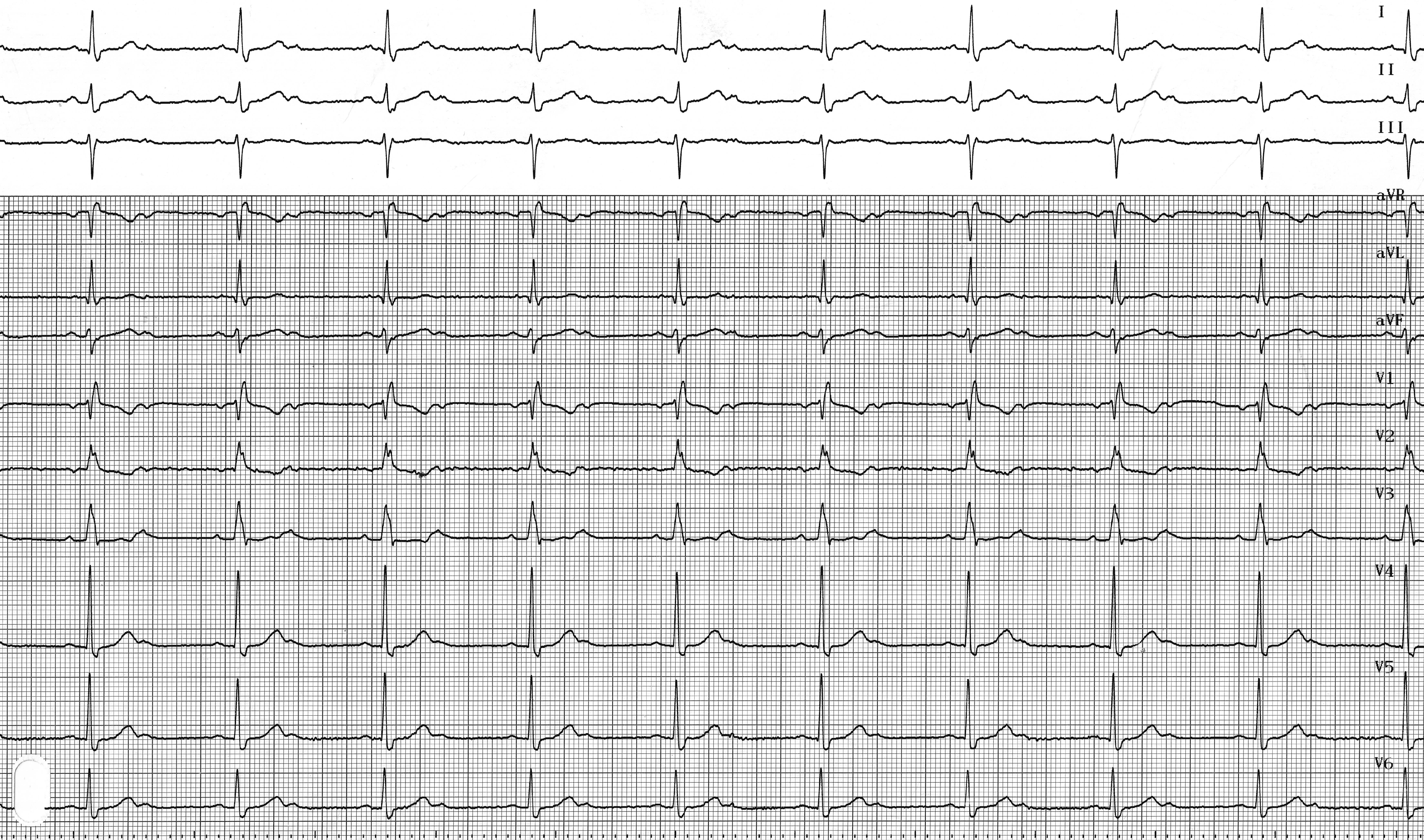 trace-1-8-ecg