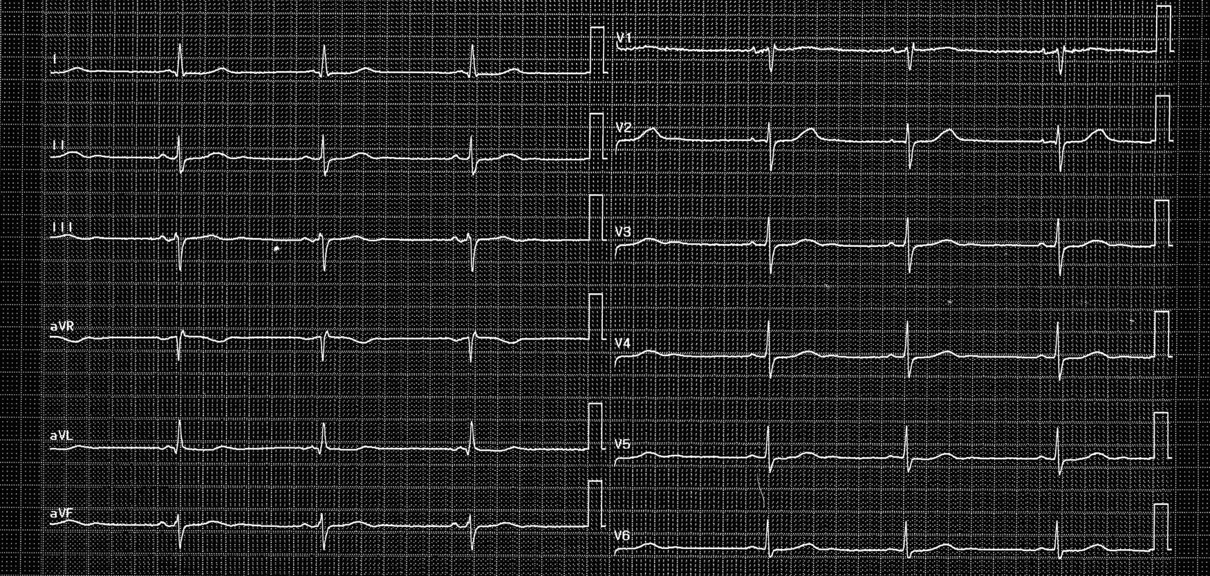 trace-2-1-ecg