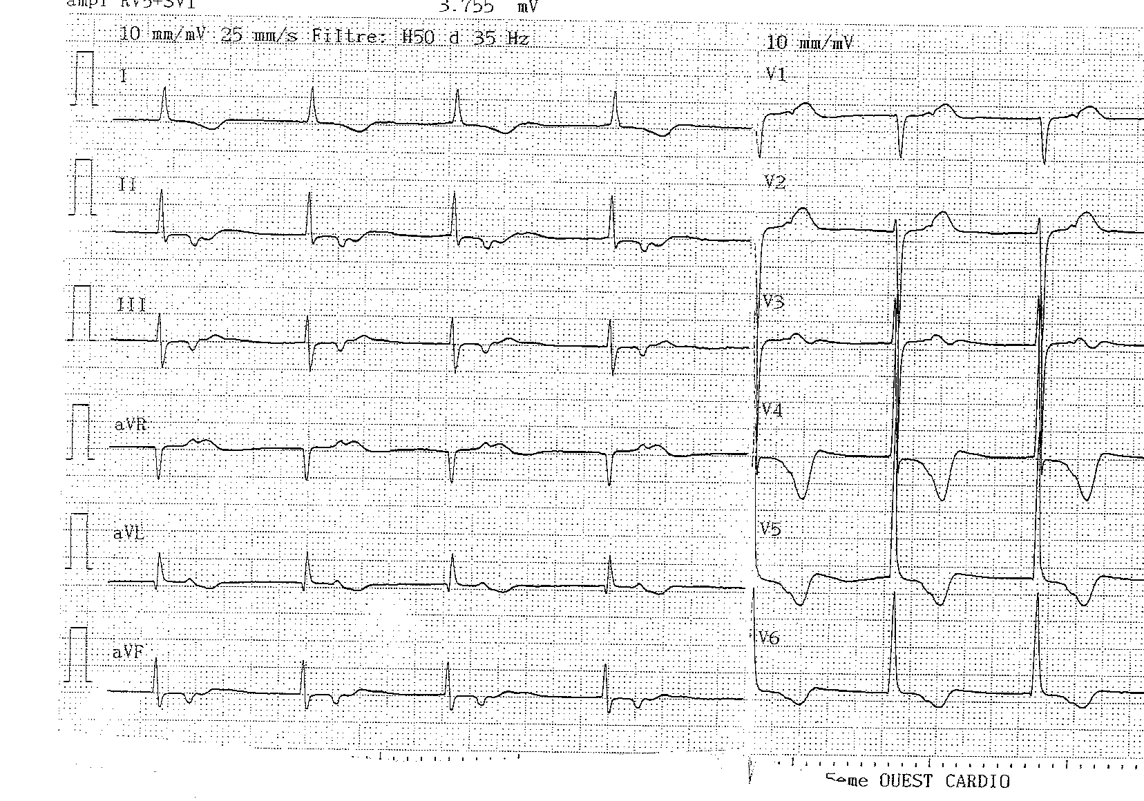 trace-2-2-ecg