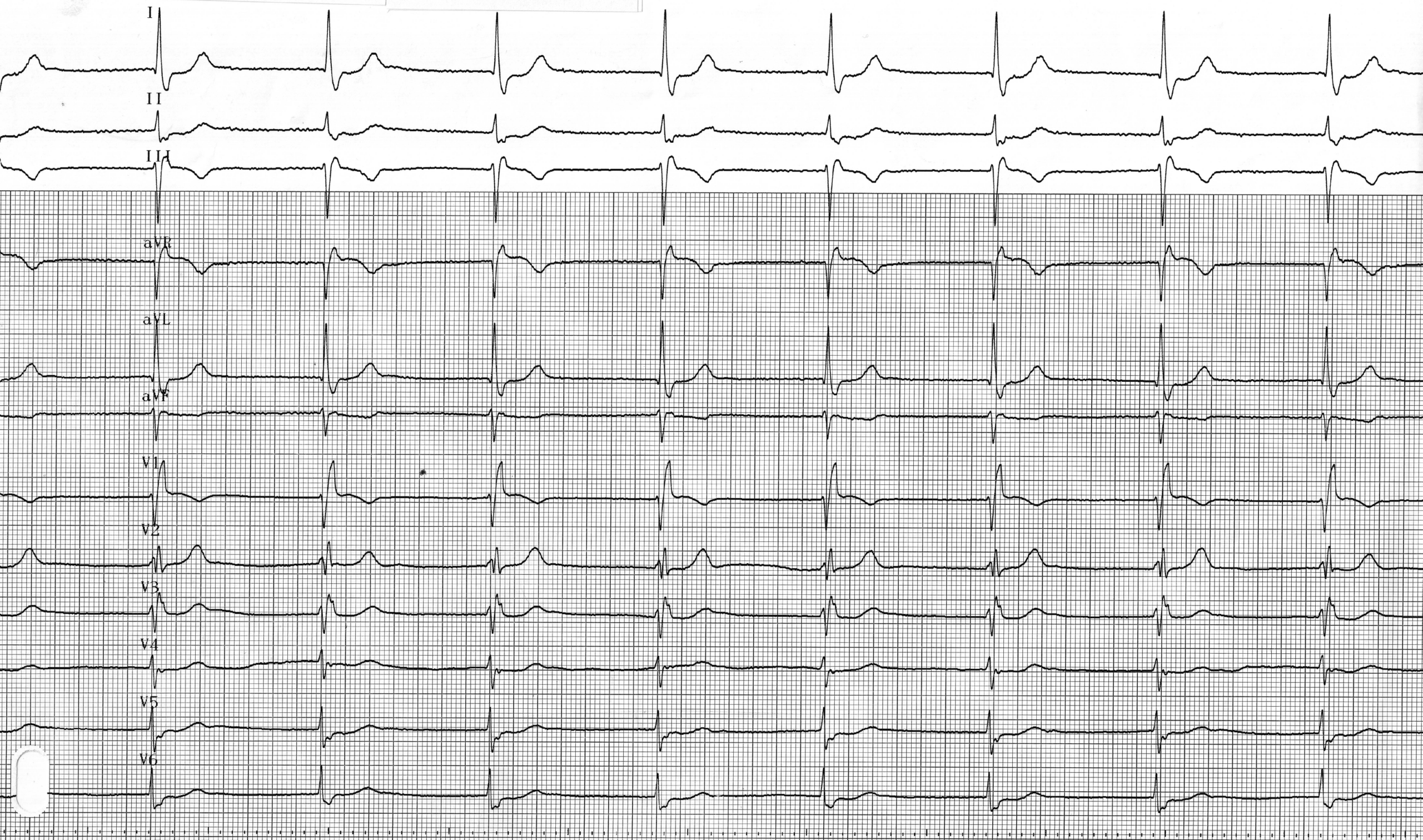 trace-2-3-ecg