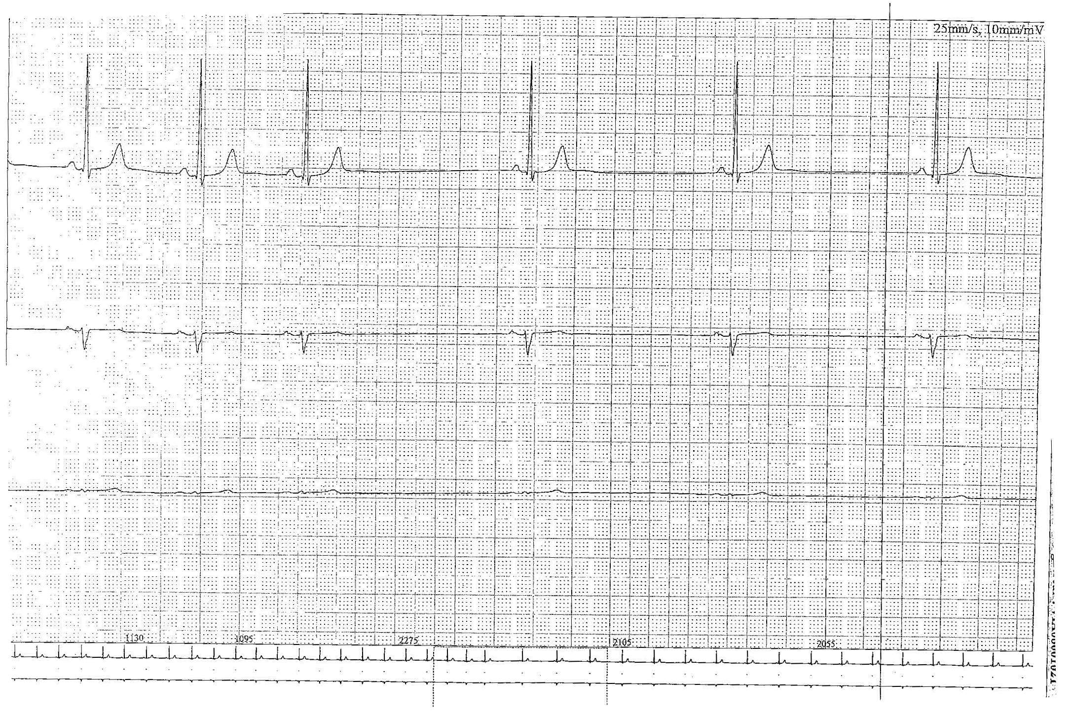 trace-2-4-ecg