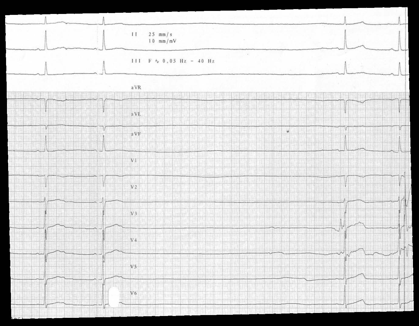trace-2-5-ecg