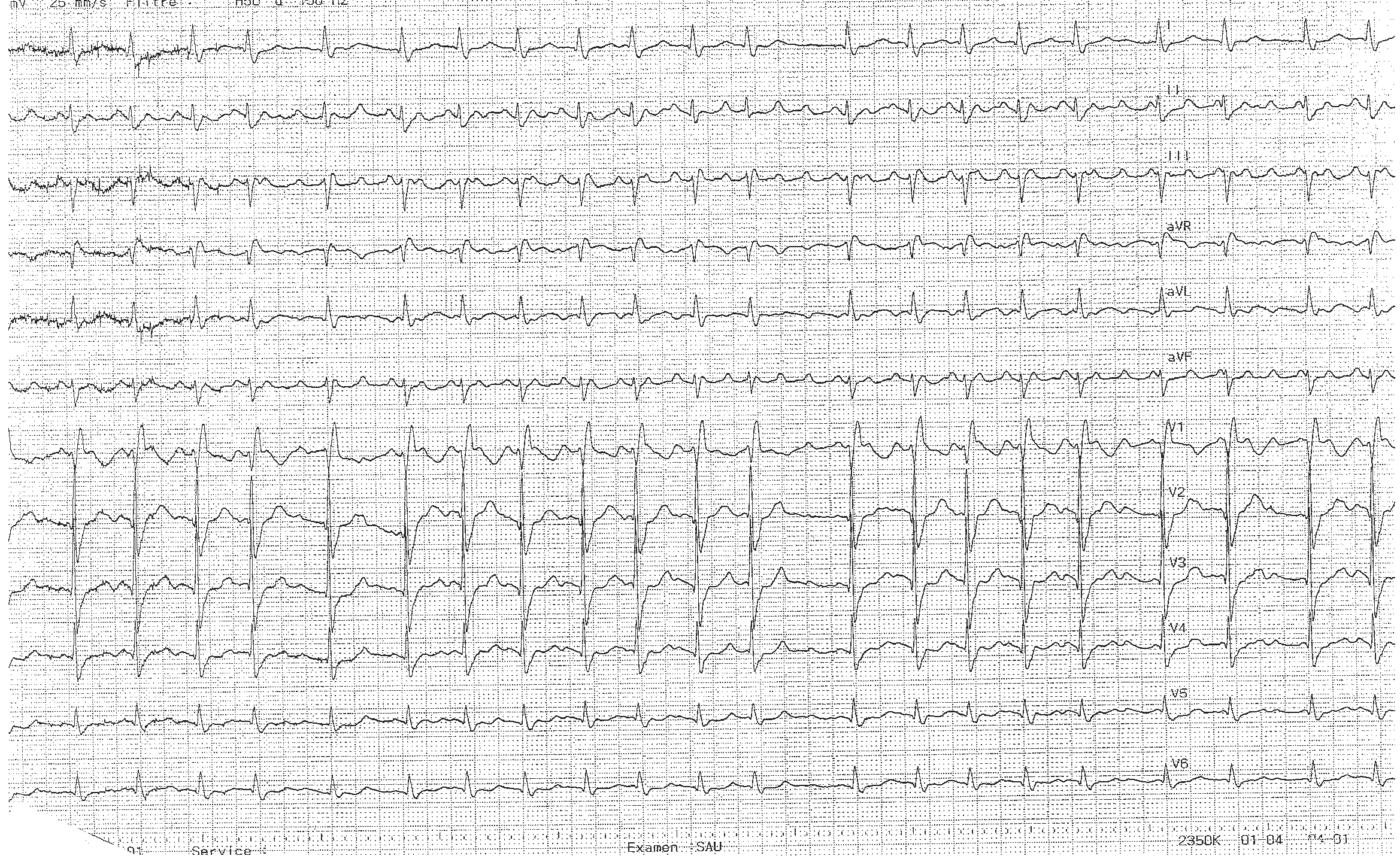 trace-2-7-ecg