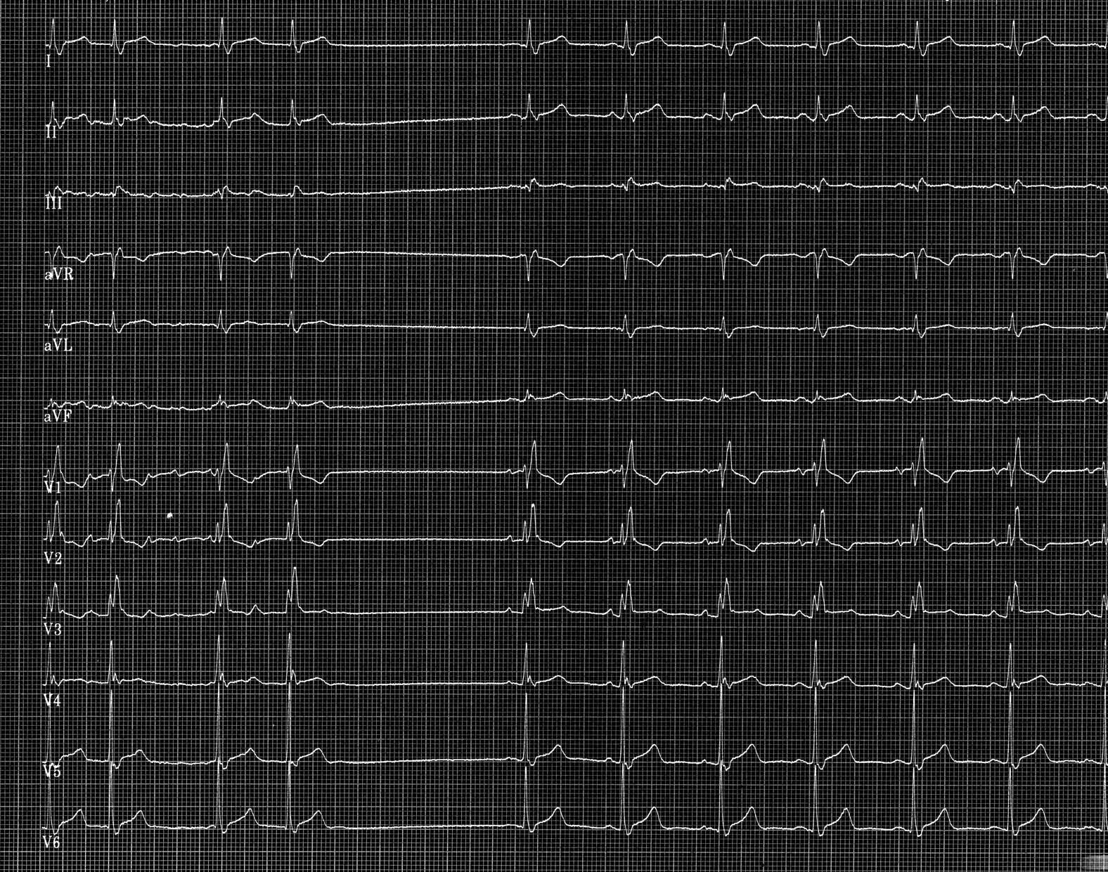 trace-2-8-ecg