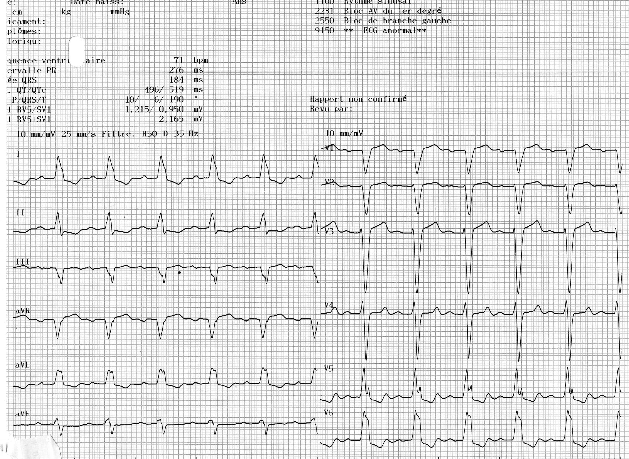 trace-3-1-ecg-7