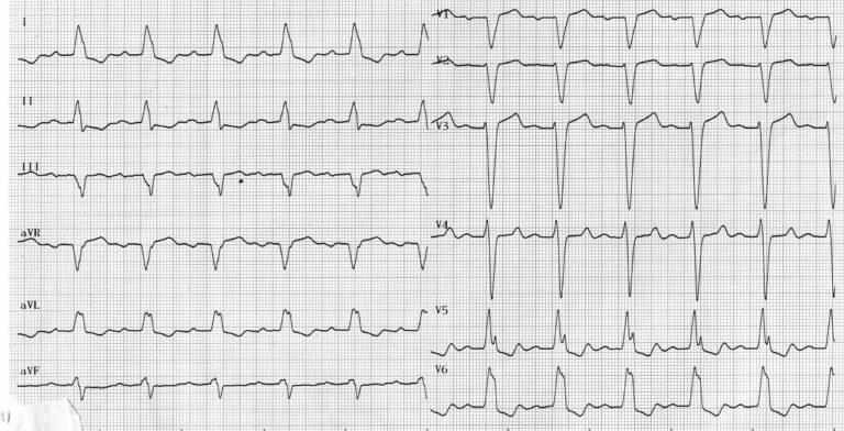 trace-3-1-ecg
