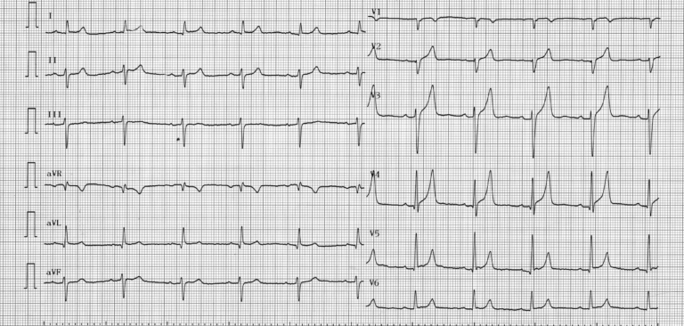 trace-3-10-ecg