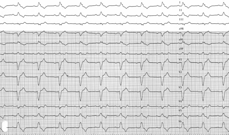 trace-3-2-ecg