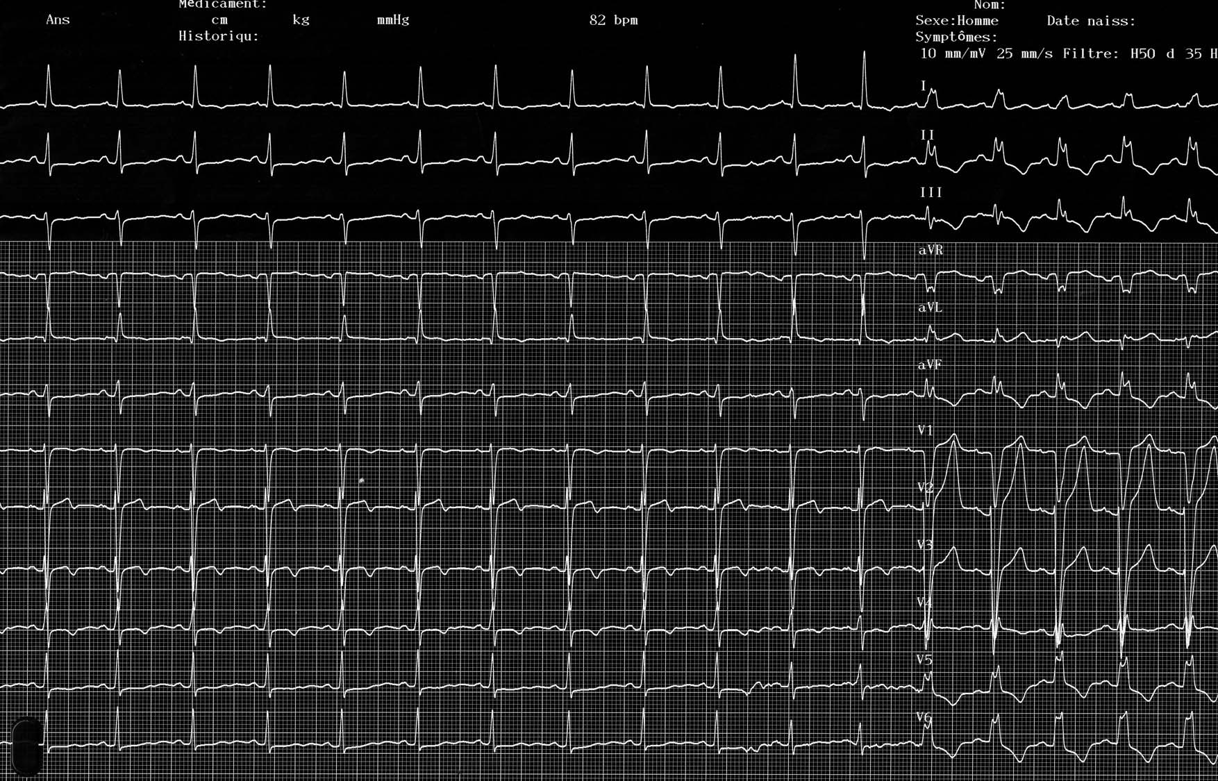 trace-3-3-ecg