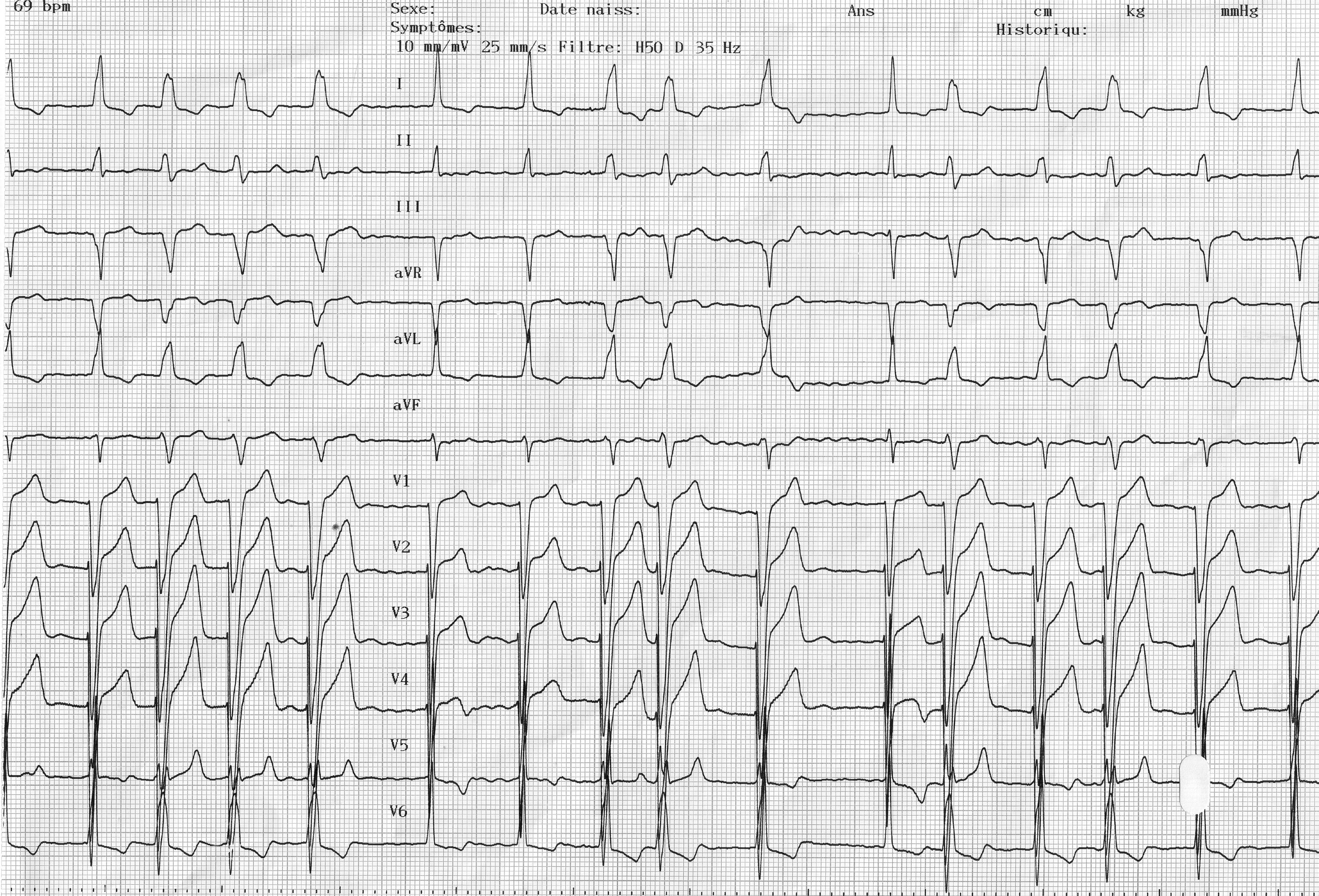 trace-3-4-ecg