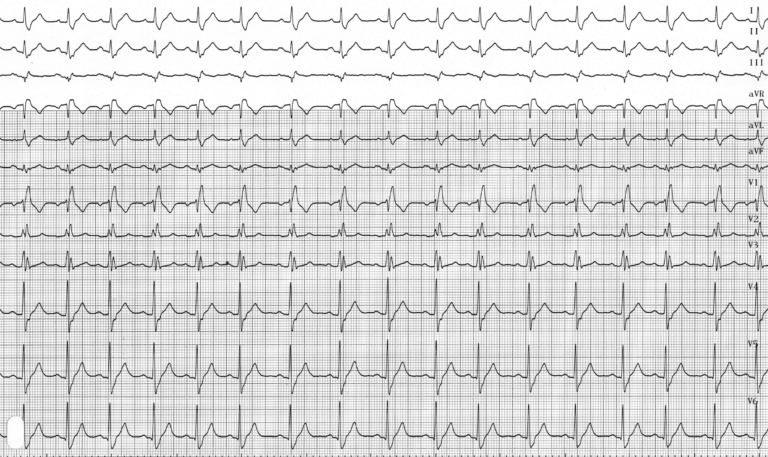 trace-3-5-ecg