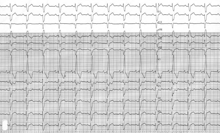 trace-3-6-ecg