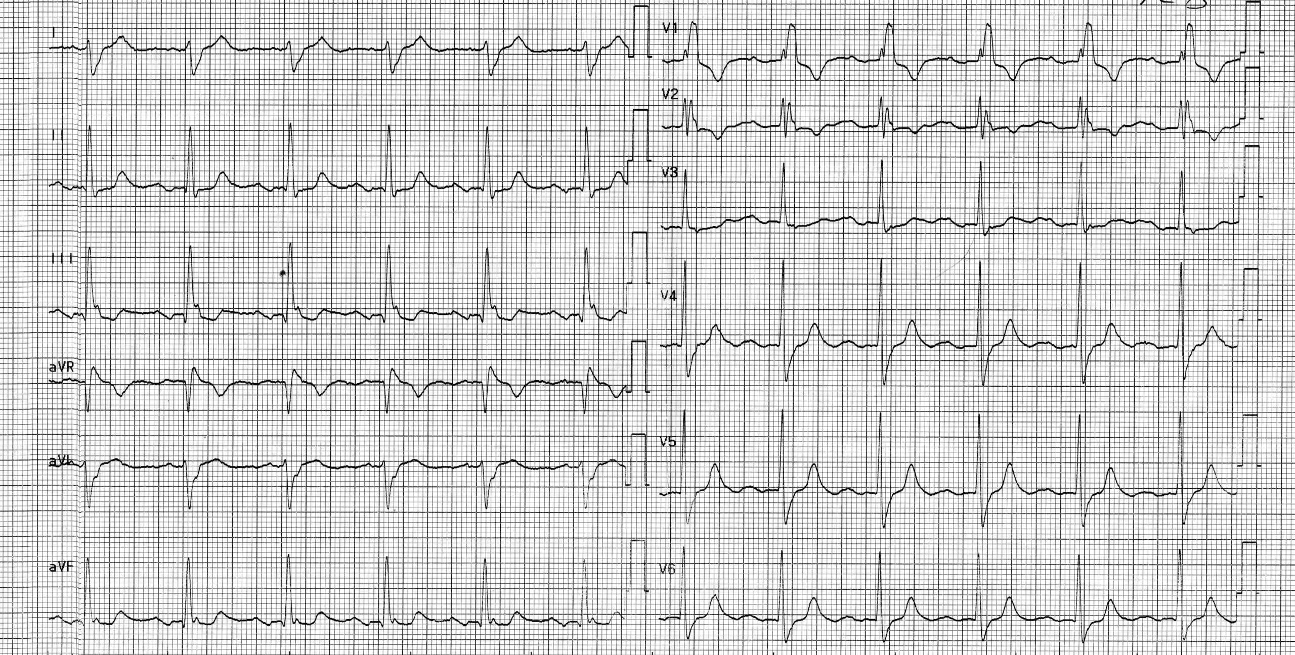 trace-3-7-ecg