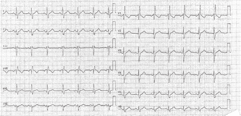 trace-3-8-ecg