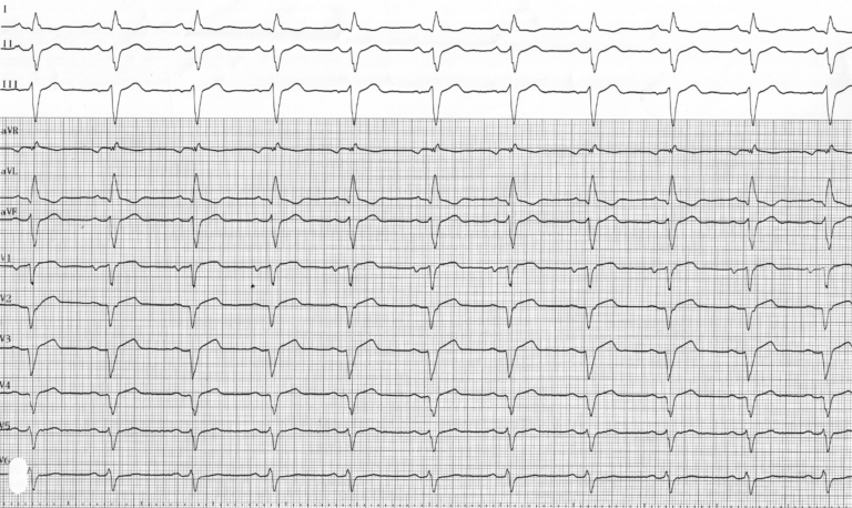 trace-3-9-ecg