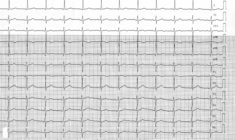 trace-4-1-ecg