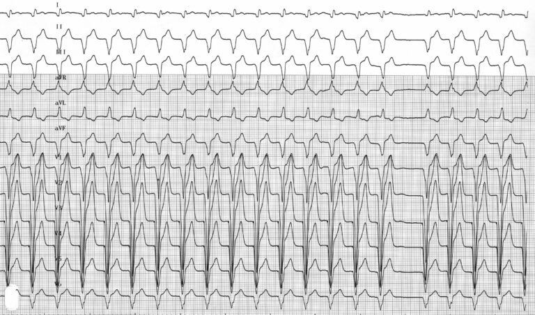 trace-4-10-ecg