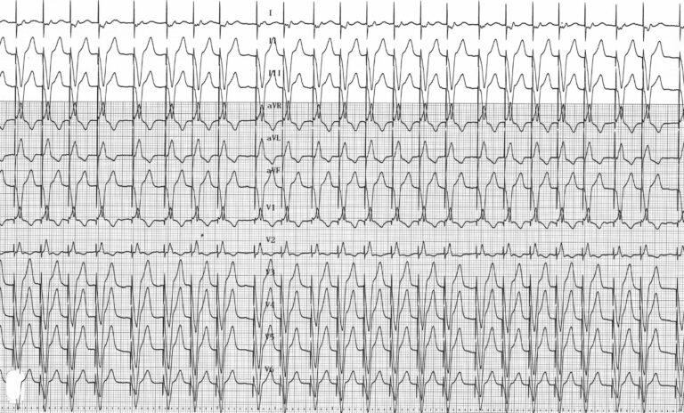 trace-4-11-ecg