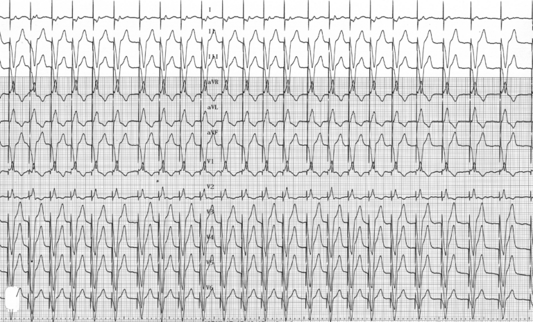trace-4-12-ecg
