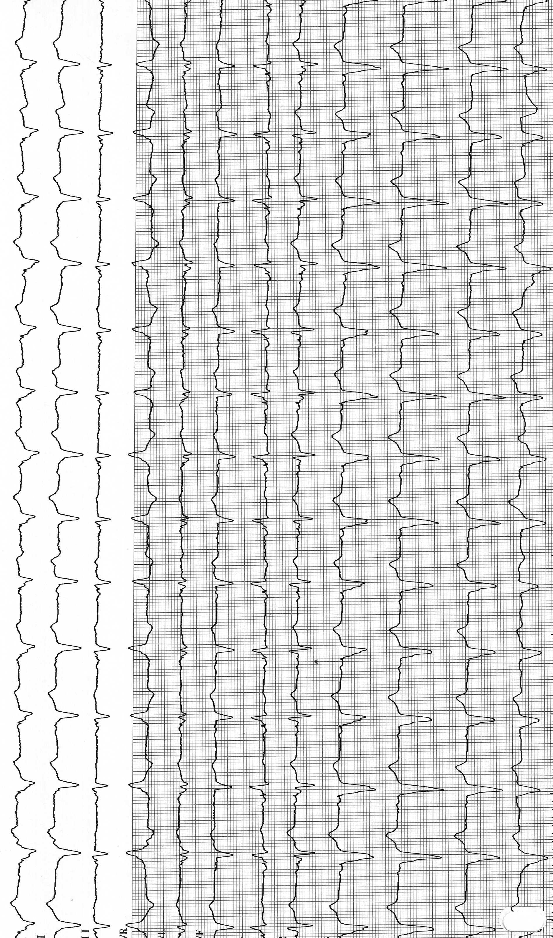 trace-4-13-ecg