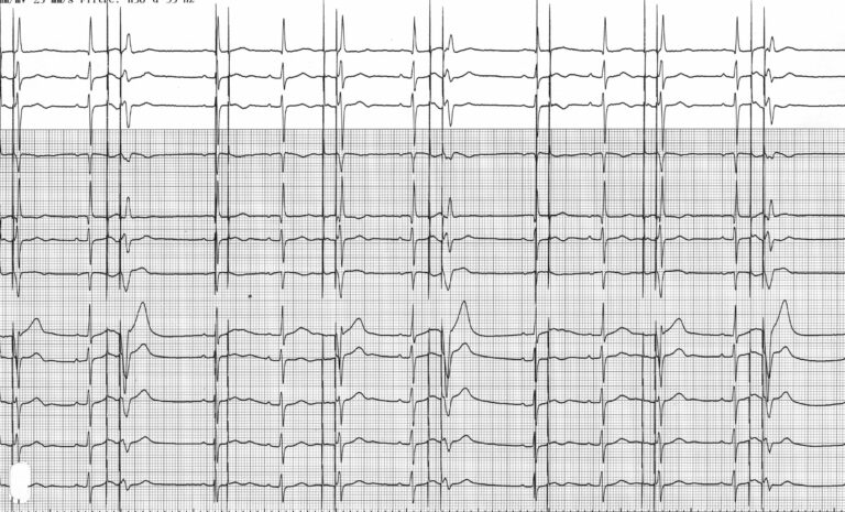 trace-4-2-ecg