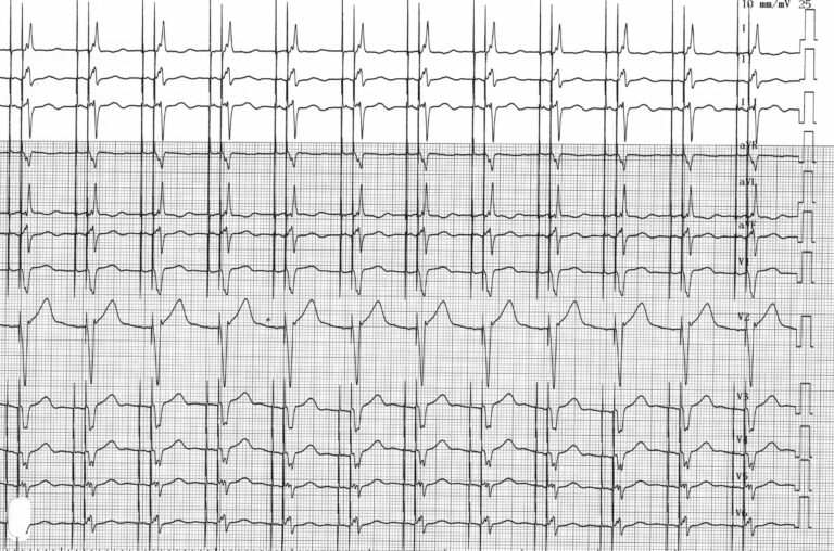 trace-4-3-ecg