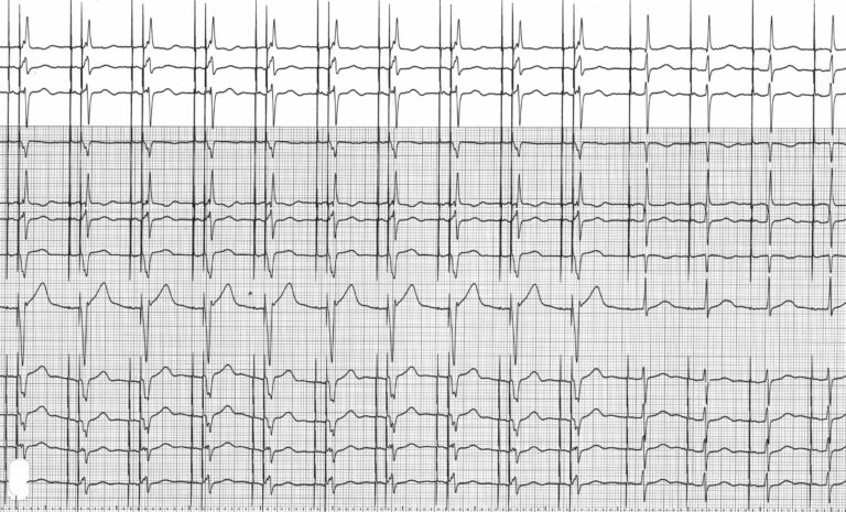 trace-4-4-ecg