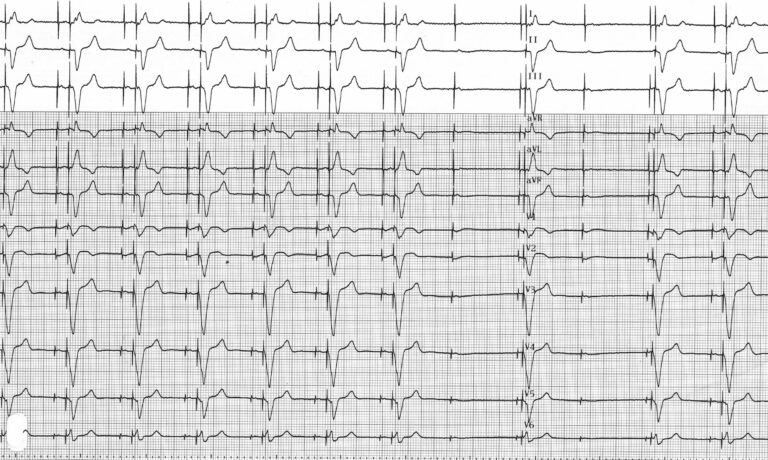 trace-4-5-ecg